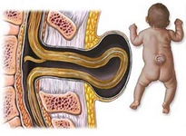 Bebeklerde Kuyruk Sokumu Açıklığı Belirtileri ve Tedavisi